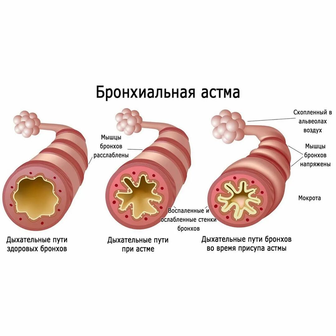 Почему ба. Бронхиальная астма воспаление дыхательных путей. Строение легких и бронхов при астме. Обструкция дыхательных путей при бронхиальной астме. Механизм обструкции дыхательных путей при бронхиальной астме.