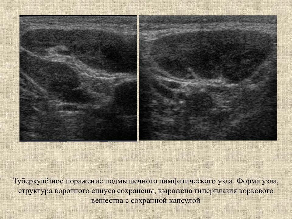 Лимфоузлы гиперплазированы. УЗИ лимфатических узлов подмышечных впадин. УЗИ аксиллярных лимфоузлов. Реактивный лимфаденит на УЗИ. Ультразвуковая картина лимфатического узла.