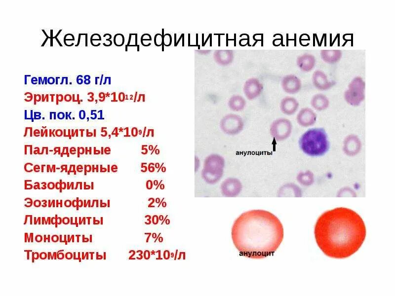 Железодефицитная анемия дефицитная лейкоциты. Эозинофилы при железодефицитной анемии. Лейкоциты при железодефицитной анемии. Железодефицитная анемия тромбоциты. Эозинофилы моноциты тромбоциты