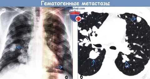Метастазы в легких без лечения