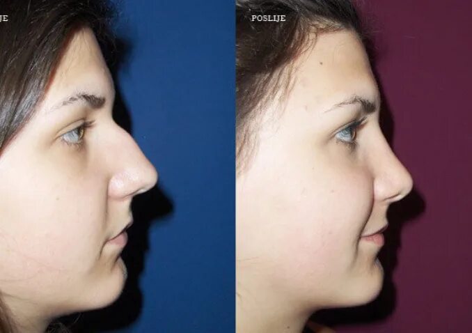 Ринопластика кончика носа. Ринопластика. Кончик носа белеет. Ринопластика уменьшение кончика носа. Ринопластика вид спереди.