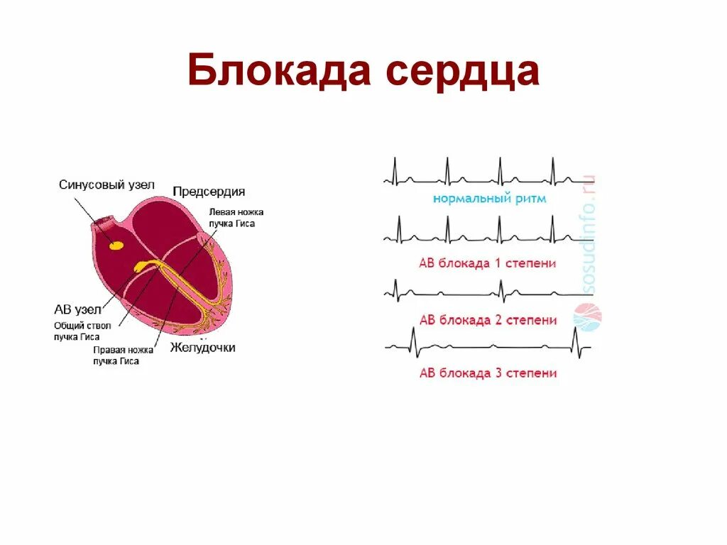 Блокада сердца опасно для жизни