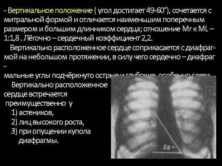 Вертикальная позиция сердца. Средостение рентген анатомия. Положение сердца на рентгенограмме. Рентген анатомия сердца. Вертикальное сердце на рентгене.