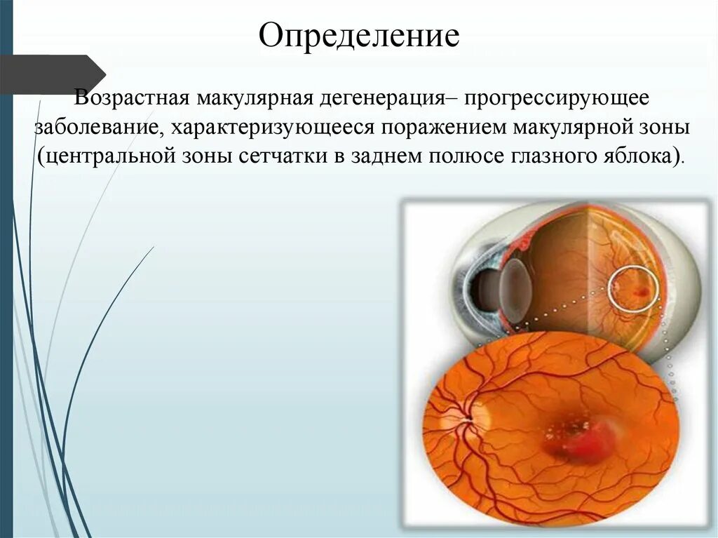 Лечение дегенерации макулы. Макулодистрофия, макулярная дегенерация. Макулярная дегенерация глаза. Возрастная макулодистрофия сетчатки. Возрастная макулярная дегенерация формы.