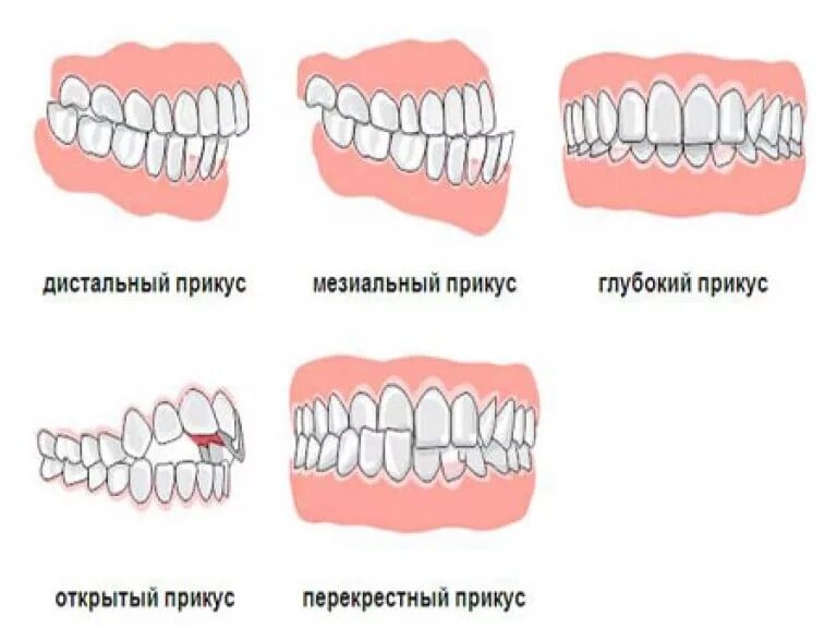 Как понять прикус. Правильный прикус и неправильный прикус. дистальный перекрестный прикус. открытый передний прикус схема. прикус зубов правильный и неправильный у детей 4-5 лет.