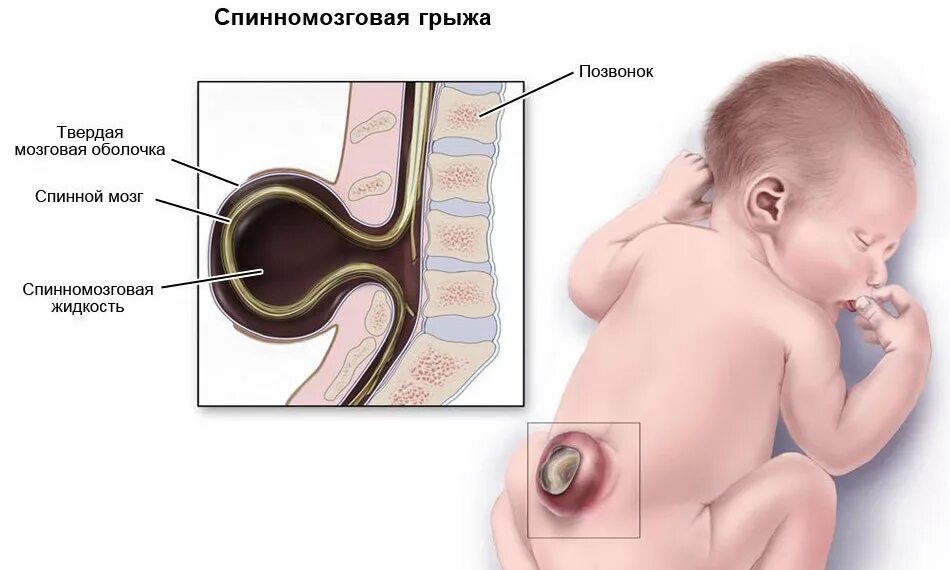 Внутриутробное недоразвитие головного мозга. Спинномозговая грыжа у новорожденных. Спинномозговые грыжи пороки развития. Гидроцефалия и спинномозговая грыжа. Патологии плода спинномозговая грыжа.