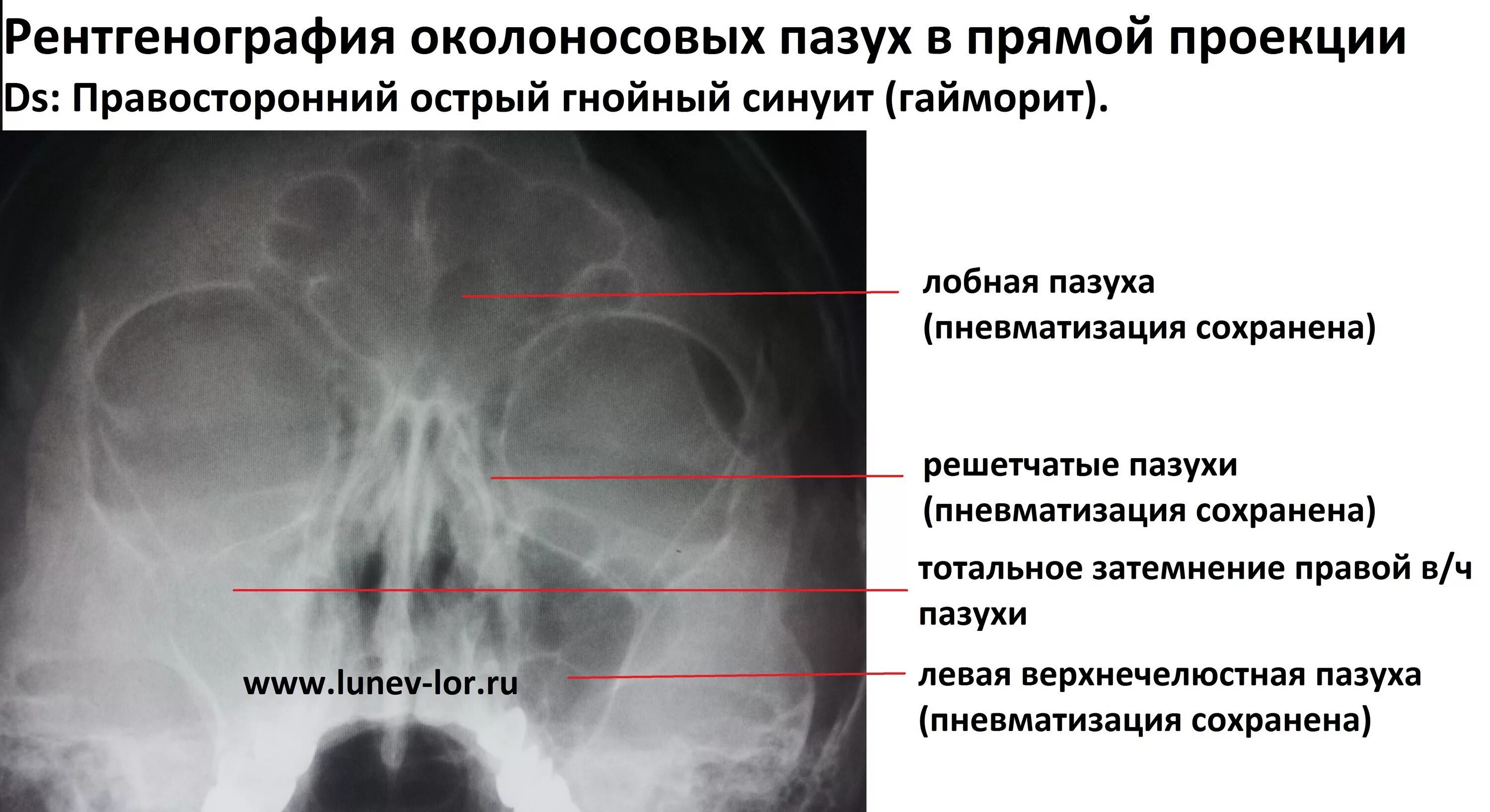 Гайморовы пазухи вид снизу. Экссудативный гайморит рентген. Хронический синусит рентген описание. Тотальное затемнение верхнечелюстной пазухи рентген. Локальное утолщение слизистой