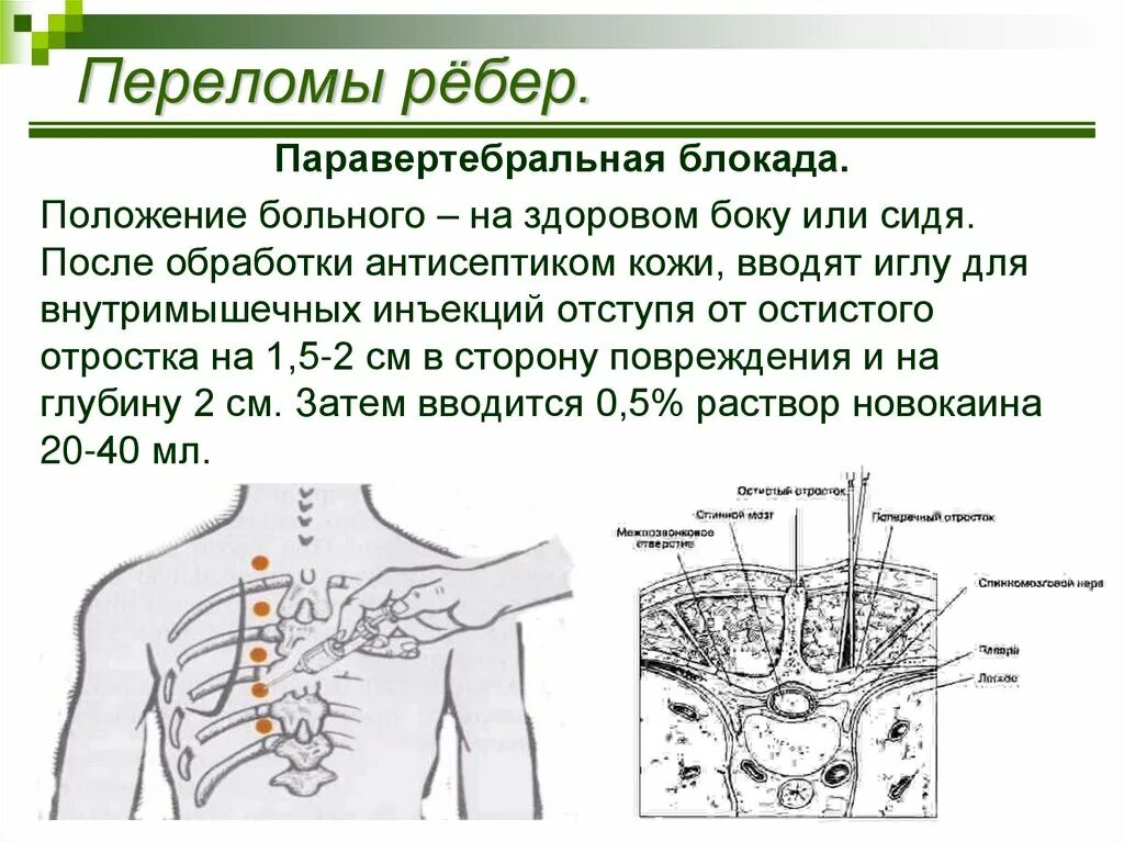 Блокада показания. Техника выполнения паравертебральной блокады поясничного отдела. Техника новокаиновой блокады межреберных нервов. Паравертебральная блокада грудного отдела. Шейная паравертебральная блокада методика.