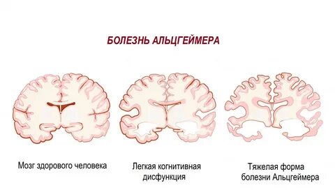 Височный тип мозга что такое