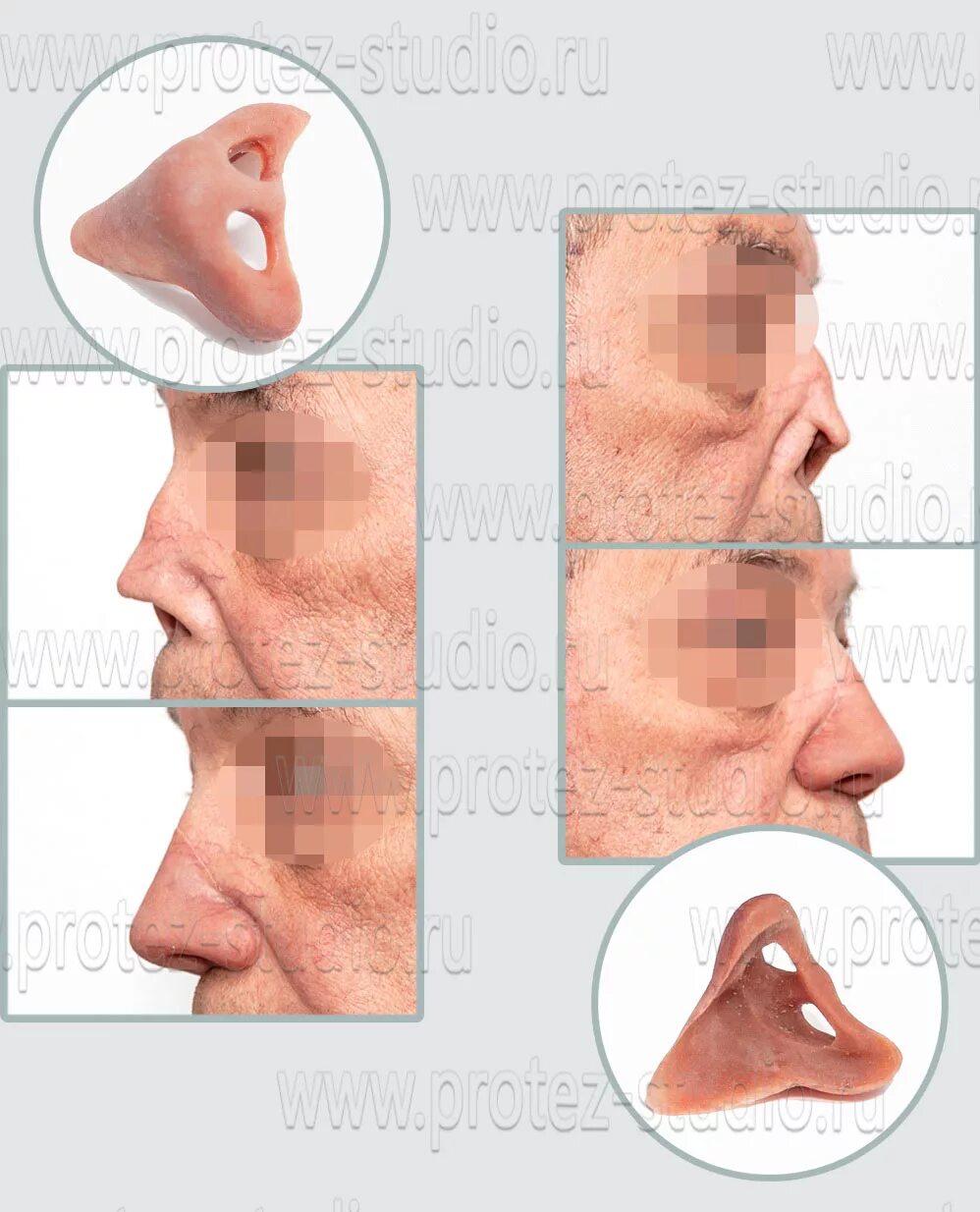 Силиконы для изготовления лицевых протезов. Глазной протез пластмассовый. Искусственный нос. Лицевое протезирование. Лицевое протезирование.