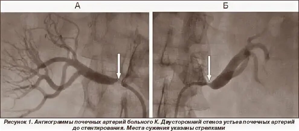 Стеноз 80