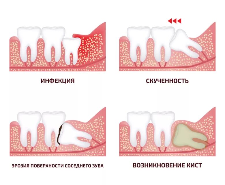 Сложное удаление зуба