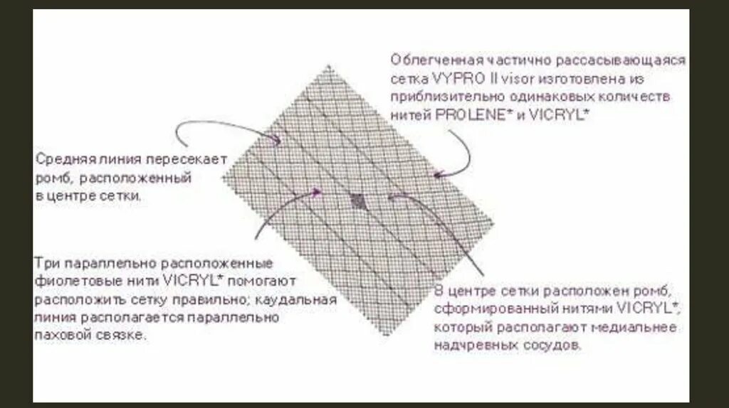 Сетчатый имплант для грыжи. Сетка для операции паховой грыжи. Сетка для операции на грыжу