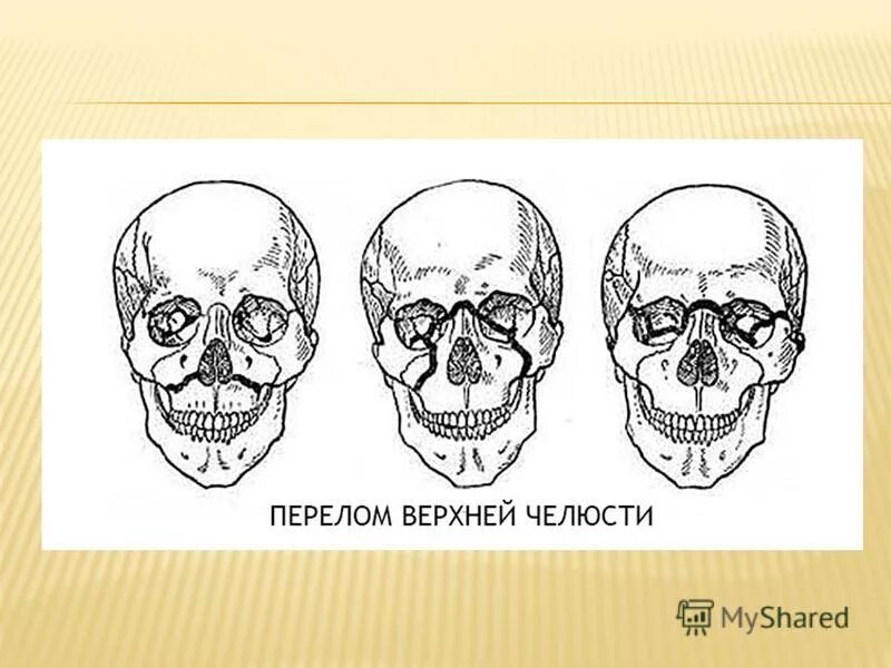 Перелом лицевого черепа