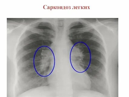 Саркоидоз легких