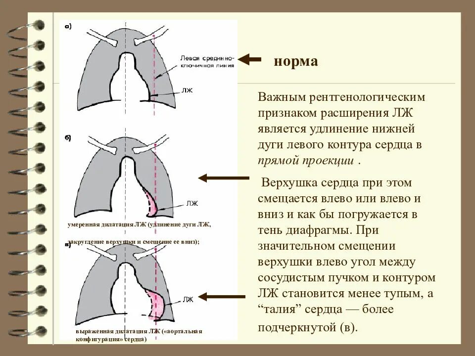 Понижение давления воздуха в легких. Лобэктомия верхней доли легкого. Инфильтративный туберкулёз лёгких рентген. Инфильтративный туберкулез рентген диагностика. Тень сердца на рентгенограмме в норме.