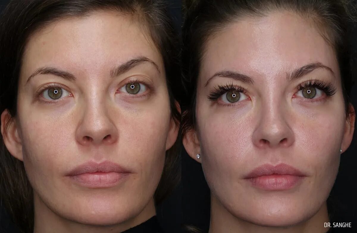 Filler under the Eyes. Under Eye Filler options.