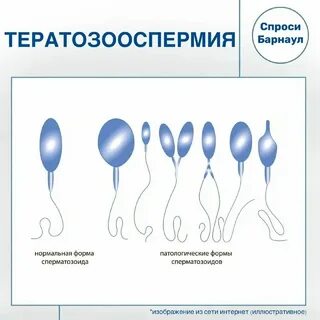 Тератозооспермия можно забеременеть