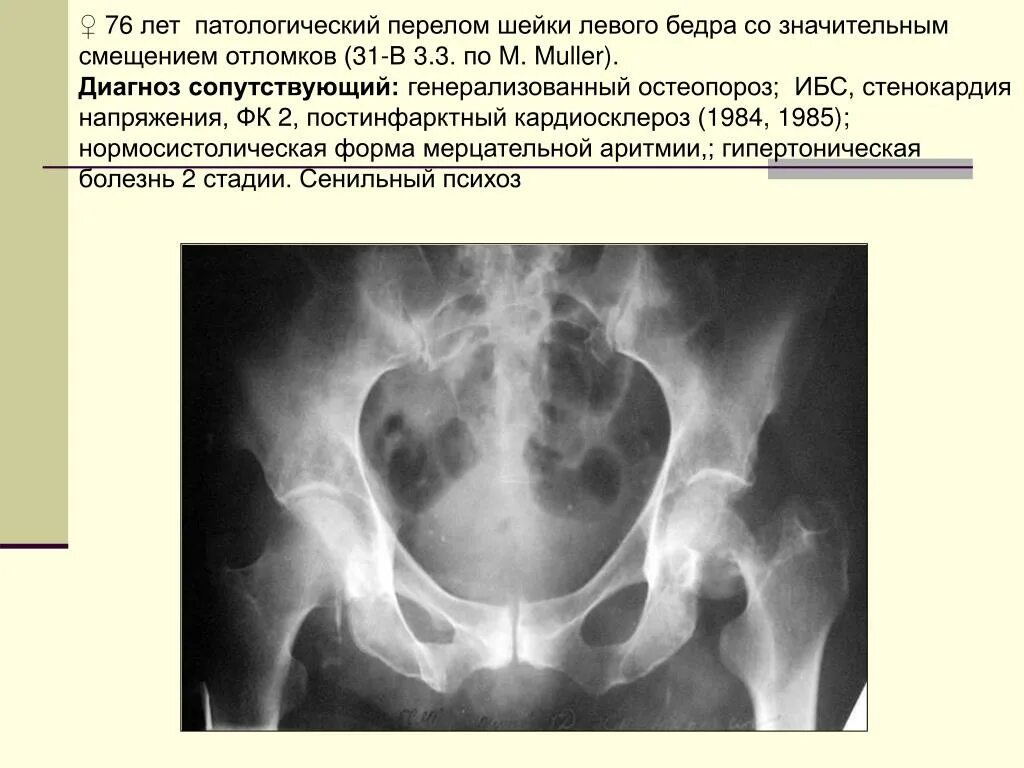 Перелом шейки бедра диагноз. Патологический перелом шейки бедра. Перелом шейки бедренной кости диагностика. Перелом шейки бедренной кости диагноз. Шейки левого бедра