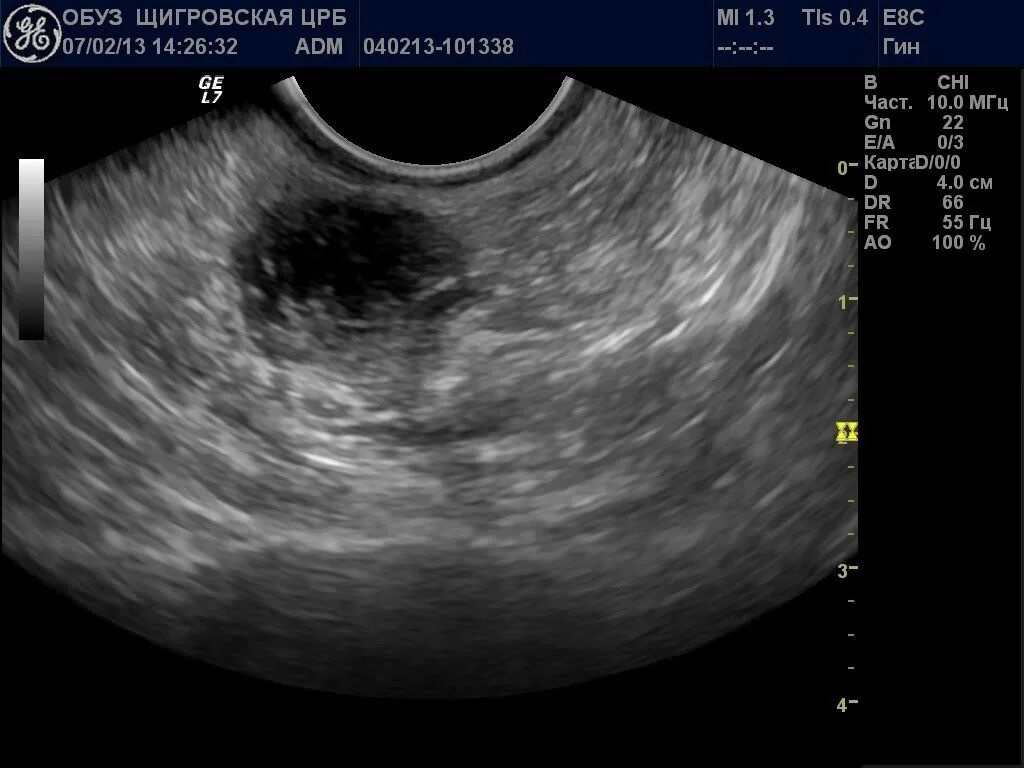 Эндометриома УЗИ картина. УЗИ малого таза эндометрий.