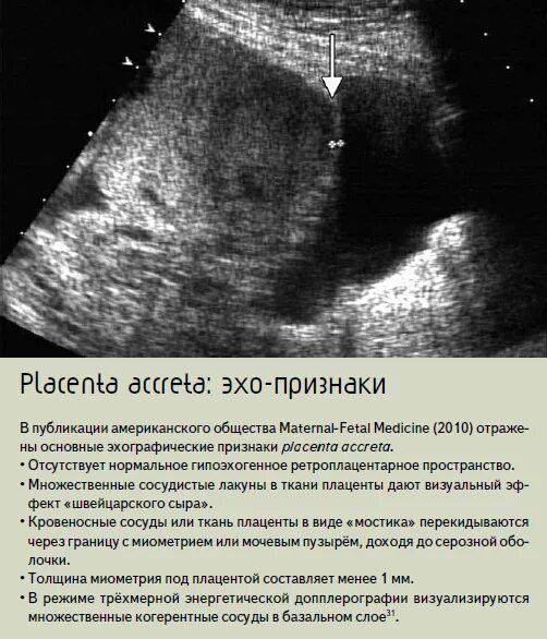 УЗИ признаки врастания плаценты. УЗИ признаки отслойки плаценты. Ультразвуковая структура плаценты. Приращение плаценты на УЗИ. Плацента на рубце матки