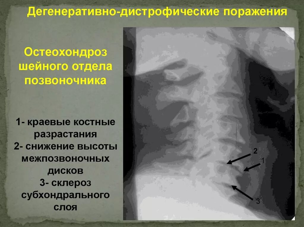 Дегенеративно-дистрофические поражения. Дегенеративные поражения позвоночника. Поражение шейного отдела позвоночника. Дегенеративные изменения шейного отдела. Начальное дегенеративные изменения шейного отдела