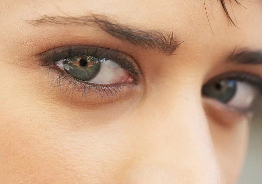 Желтые круги вокруг глаз у женщин причины. Круги под глазами. Коричневые круги под глазами. Коричневые синяки под глазами.