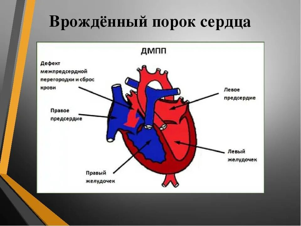 Врожденный порок сердца ДМПП. ВПС-ДМПП- дефект межпредсердной перегородки. Схемы врожденных пороков сердца.