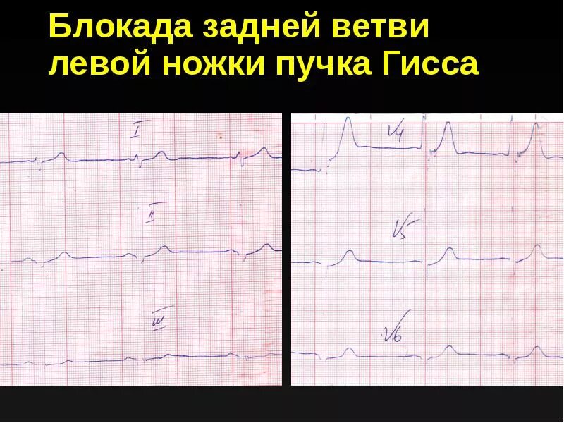 Блокада задней ножки. Блокада ветвей левой ножки пучка Гиса. Блокада нижней ветви левой ножки пучка Гиса. Блокада задне нижней ветви левой ножки пучка Гиса. Блокада задней ветви левой ножки пучка.