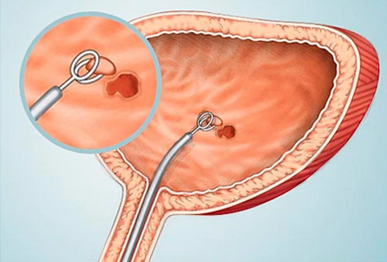 Трансуретральная резекция опухоли мочевого пузыря. Опухоль мочевого пузыря цистоскопия. Электрокоагуляция полипа уретры. Цистоскопия мочеточника. Удаление мочевого пузыря при раке