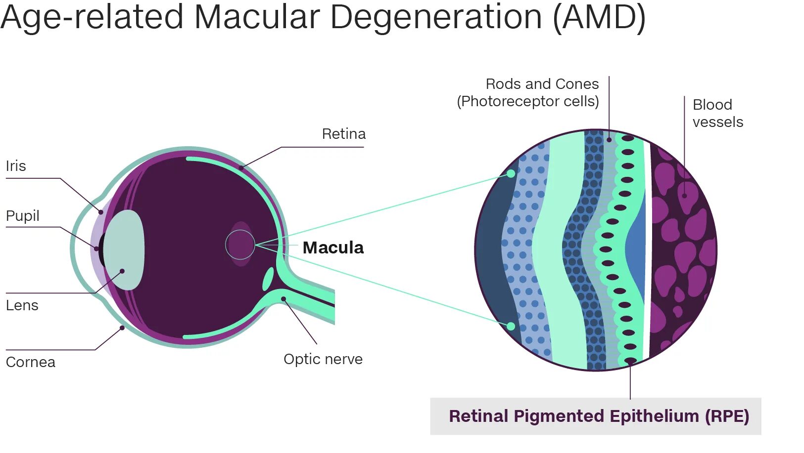 Age related Macular Degeneration Dry form.