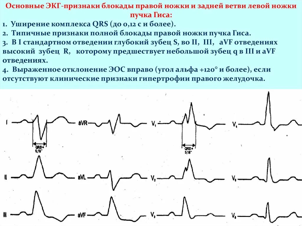 Блокада qrs. Блокада правой и левой ножки пучка Гиса на ЭКГ. Блокады ветвей пучка Гиса на ЭКГ. Блокада ПНПГ на ЭКГ. ЭКГ критерии блокады левой ножки пучка Гиса.