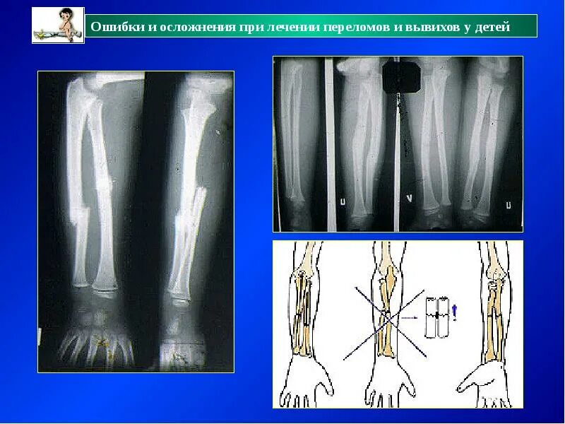 Осложнения переломов и вывихов. Осложнения нелеченного перелома на. Возможное осложнение перелома