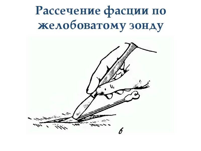 Рассечение термин. Техника рассечения фасции. рассекают по желобоватому зонду. рассечение фасции с помощью желобоватого зонда.