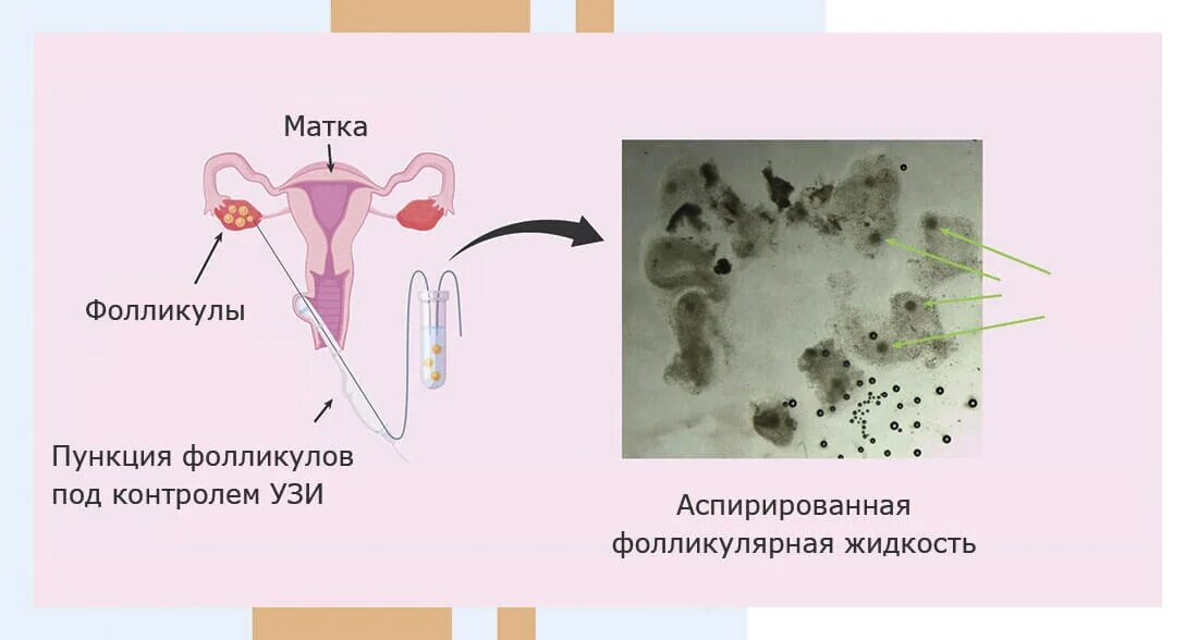 Пункция фолликулов яичника. Пункция фолликулярных яичников. Трансвагинальная пункция фолликулов. Боли после пункции фолликулов