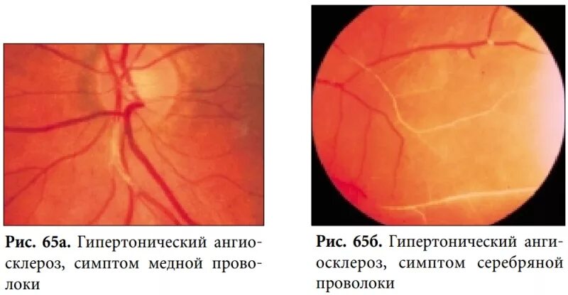 Ангиосклероз сосудов глазного дна. Гипертоническая ретинопатия глазное дно. Ангиопатия и ретинопатия сетчатки. Гипертоническая ретинопатия Салюс. Сетчатки по гипертоническому типу