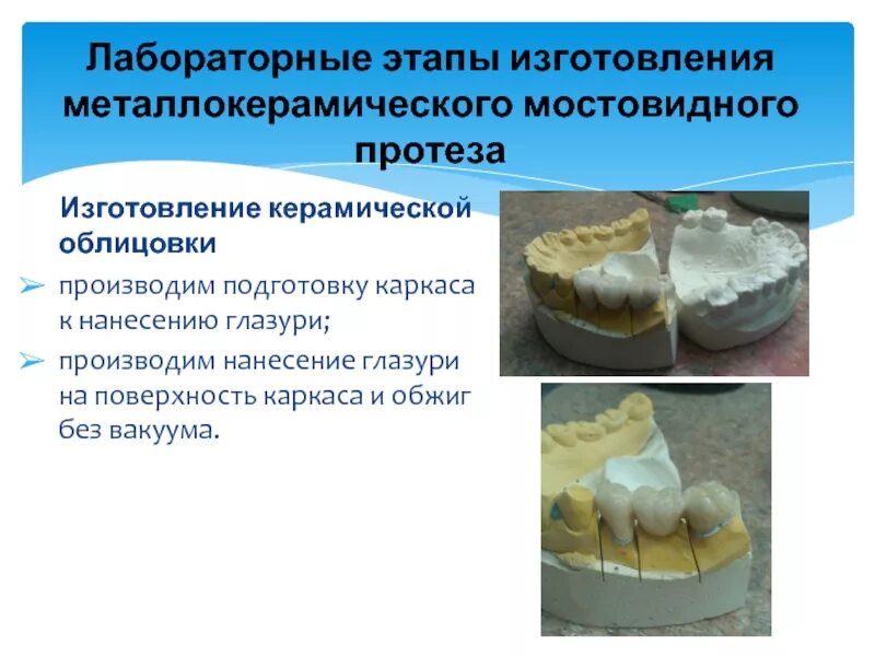 Лабораторные этапы изготовления протезов. Лабораторные этапы изготовления мостовидных протезов. Этапы изготовления мостовидного протеза. Инструменты для изготовления мостовидных протезов. Лабораторные этапы металлокерамической коронки