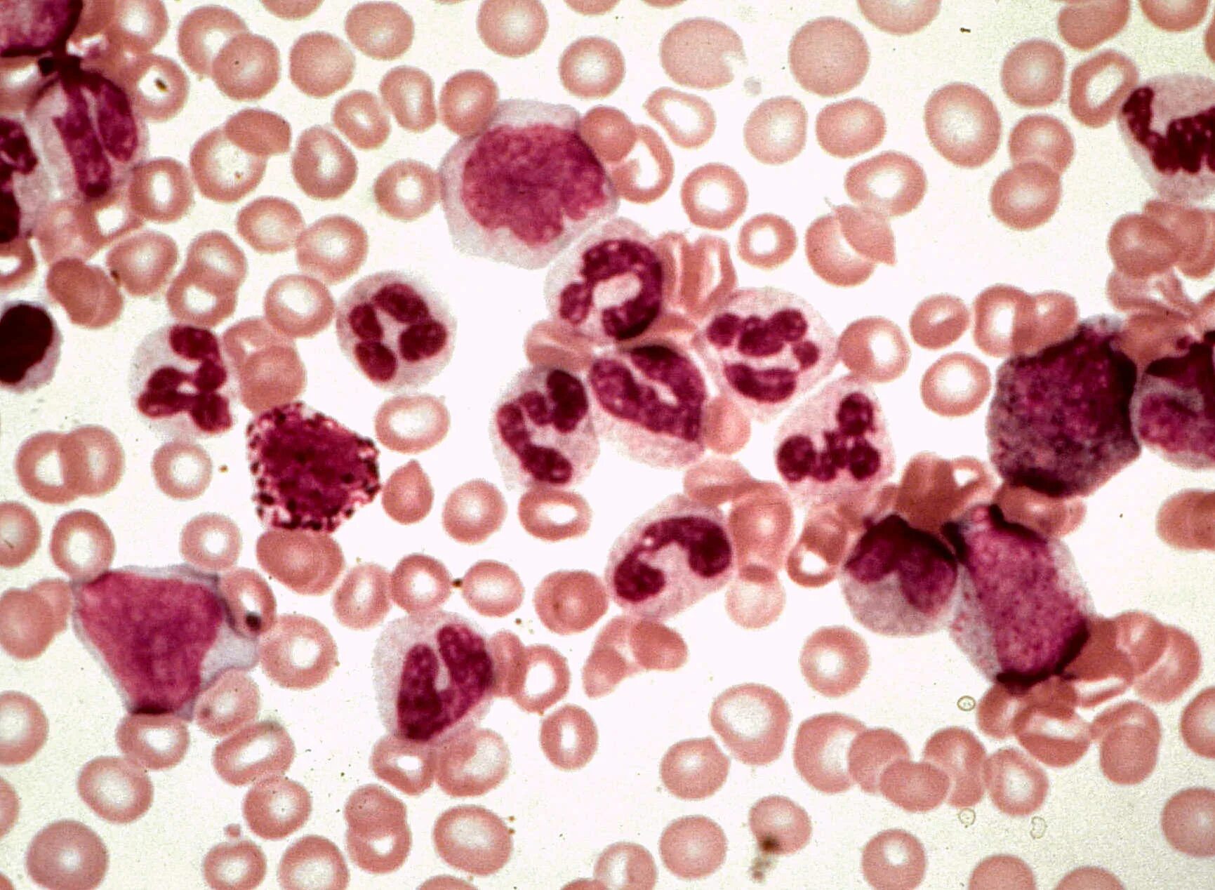 Хронический лимфоцитарный лейкоз КРС. Лейкоз крупного рогатого скота кровь. Лейкоз клетки крови. Заболевание крови миелолейкоз.