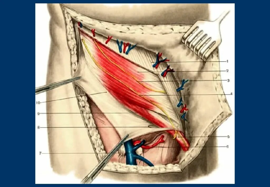 Брюшная стенка после операции. Хирургическая анатомия передней брюшной стенки. Дефанс мышц брюшной стенки. Подвздошно-паховый нерв анатомия. Передняя брюшная стенка.
