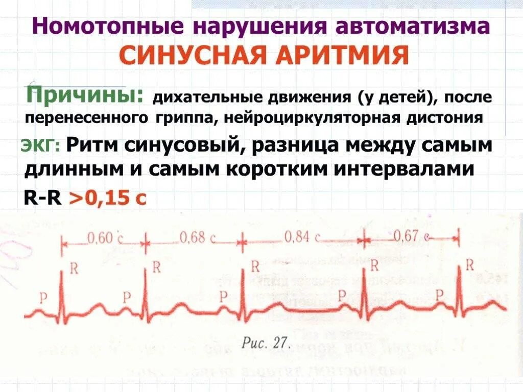 Тахикардия у ребенка 10 лет. Синусовая аритмия на экг у подростка 16 лет что это. синусовая аритмия на экг у ребенка 6 лет норма. экг при нарушениях ритма сердца у детей. экг.сердечный ритм синусовой.