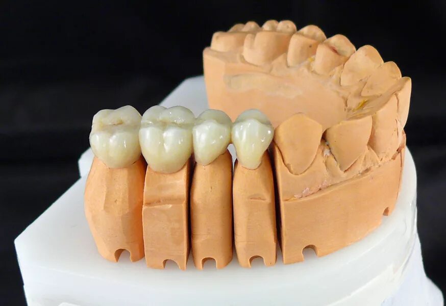 Коронка металлокерамическая (каркас КХС). Металлокерамика коронки протез мостовидный. Мостовидный протез металл керамика. Моделировка мостовидного протеза. Лабораторные этапы металлокерамической коронки