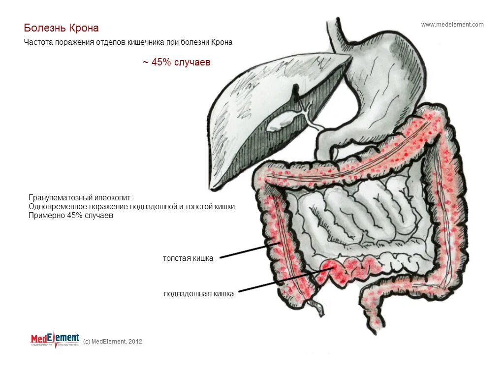 Илеоколит. Болезнь крона подвздошной кишки. Болезнь крона илеоколит. Терминальный илеит при болезни крона. Илеоколит при болезни крона.
