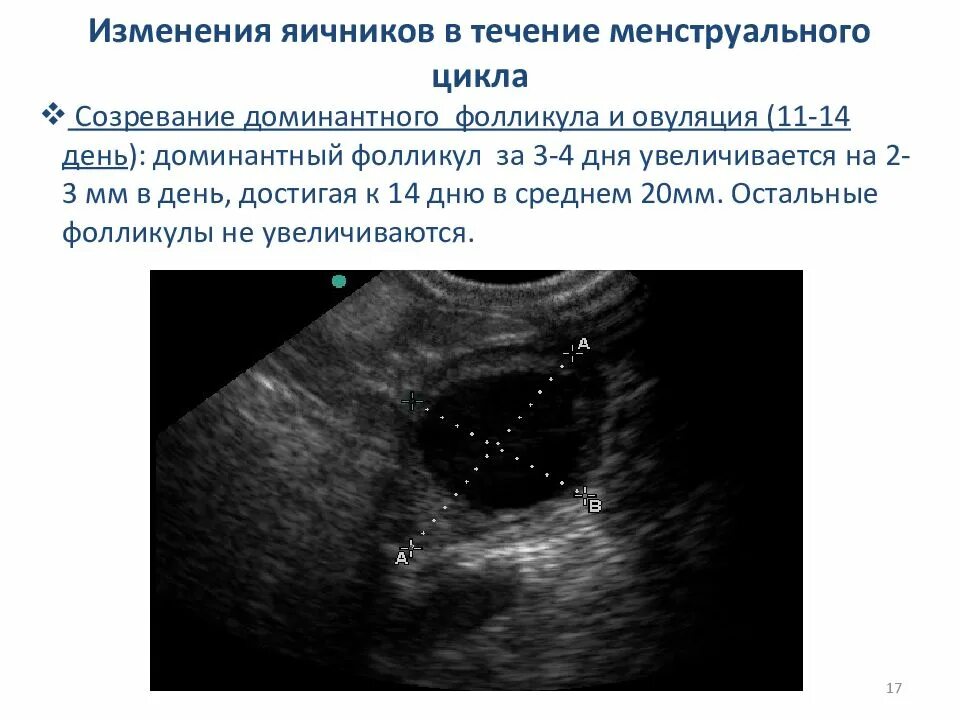 Какого размера должны быть фолликулы. Фолликул яичника 20мм УЗИ.. Доминантный фолликул на УЗИ.