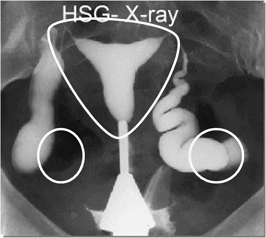 Забеременела при непроходимости труб. Гистеросальпингография (метросальпингография) МСГ. Гидросальпинкс ГСГ рентген.
