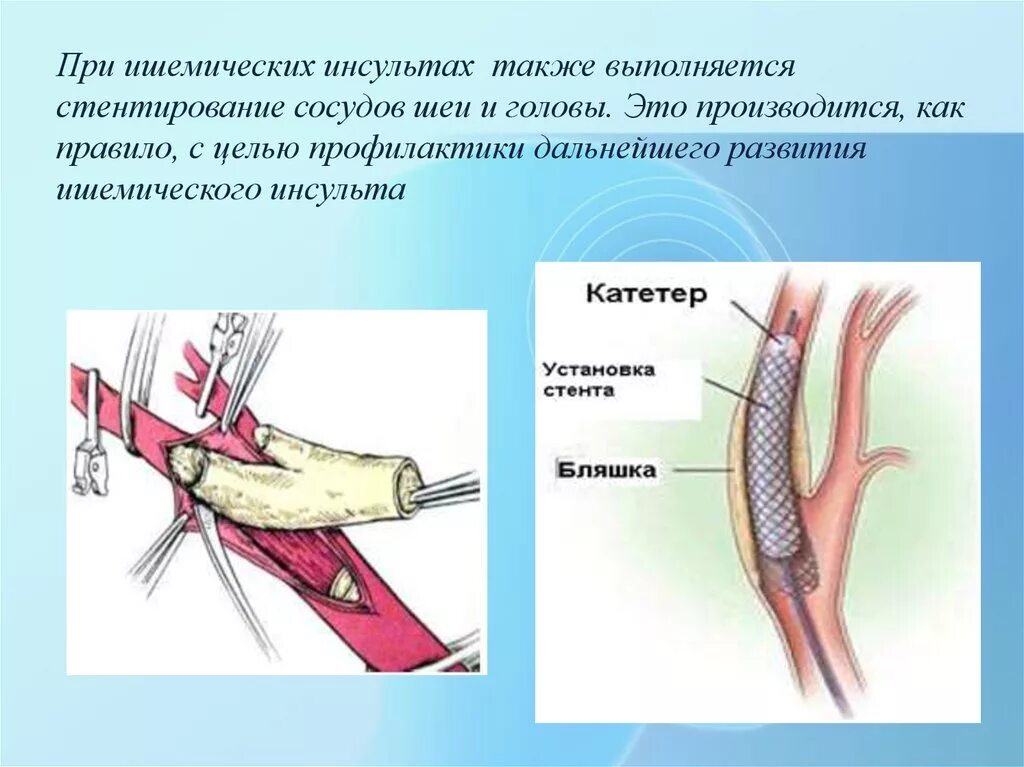 Хирургическое лечение инсульта. Операция при ишемическом инсульте. Хирургия при ишемическом инсульте. Хирургическое лечение при инсульте. При инсульте делают операцию