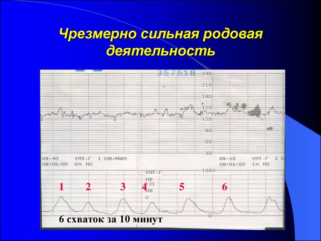 Родовая деятельность на КТГ. Как на КТГ показывает схватки. Как выглядит схватка на КТГ. Схватки на КТГ при родах. Схватки на 30 неделе