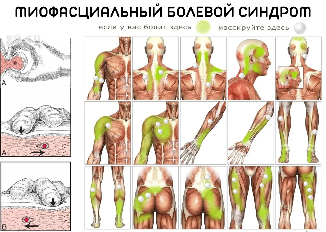 Как найти триггерную точку