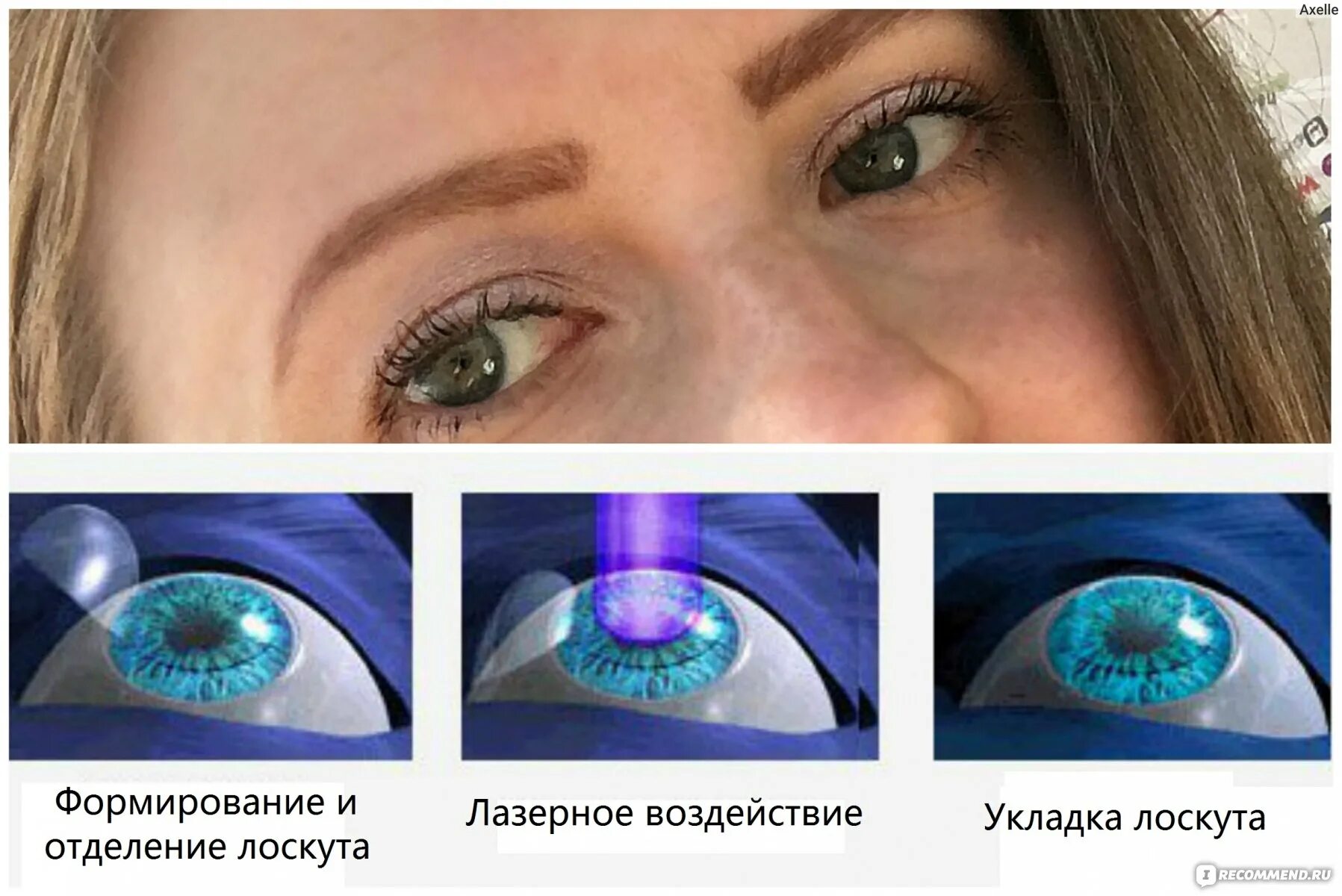 Ласик (LASIK)/Фемто ласик (Femto LASIK). Лазерная коррекция зрения Femto LASIK. Глаза после лазерной коррекции. Коррекция зрения сравнение