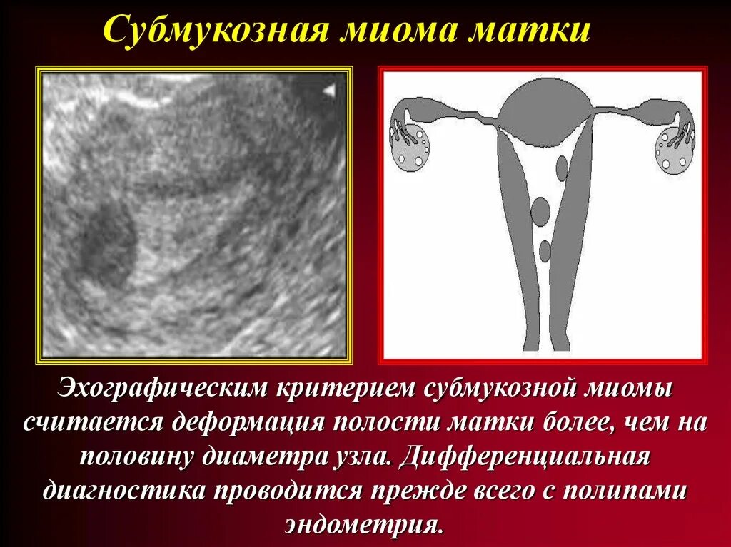 Формы миомы матки. Субмукозная миома матки. Миома деформирует полость матки. Субмукозно-интрамуральная миома матки.