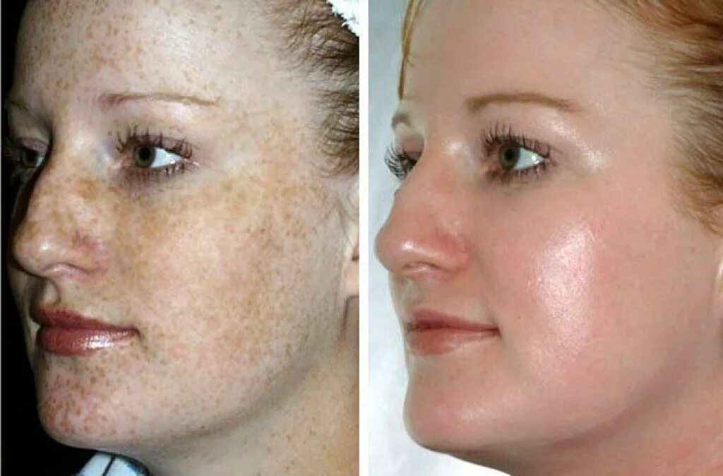 Восстановиться после чистки. Лазерная наноперфорация постакне. Пигментация на лице до и после. Пигментация кожи лица до после.